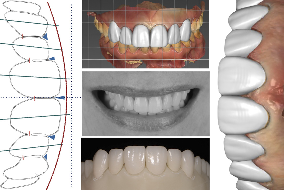 Digital Veneer